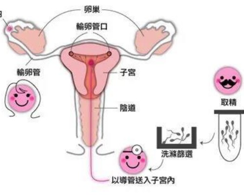 杭州单身女性生子现状：供精试管合法路径与本地私立方案对比
